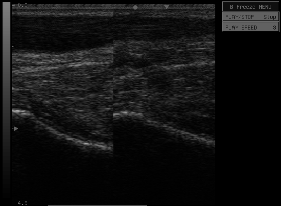 Real time Ultrasound image comparing a normal Achilles Tendon with one showing signs of tendonitis